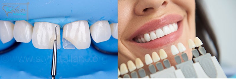 تفاوت کامپوزیت و بلیچینگ دندان در مدت زمان ماندگاری و میزان زیباتر شدن لبخند است